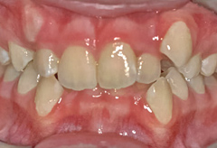 Misaligned teeth