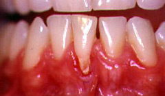 Récession gingivale