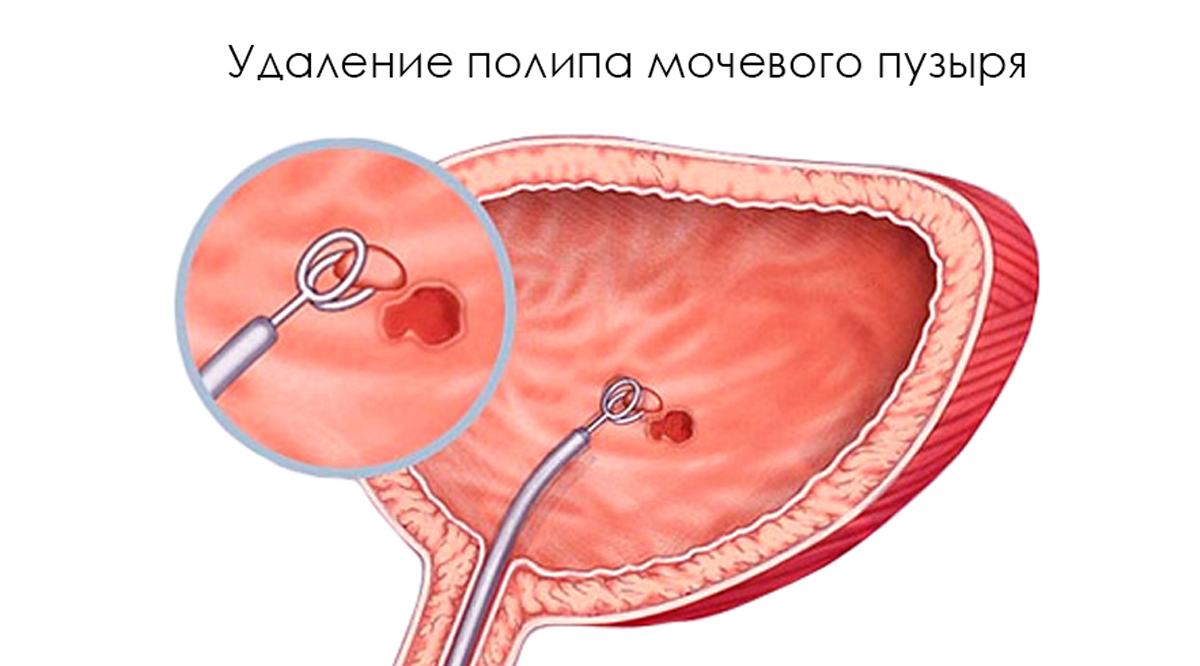 Удаленный пузырь. Фиброэпителиальный полип уретры. Полипоз мочевого пузыря.