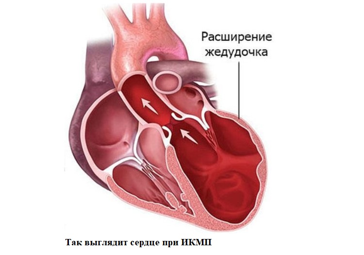Желудочка сердца расширена. Ишемическая дилатационная кардиомиопатия. ИБС дилятационная кардиомиопатия. Ишемическая кардиопатия смерть. 25.5 Ишемическая кардиомиопатия.