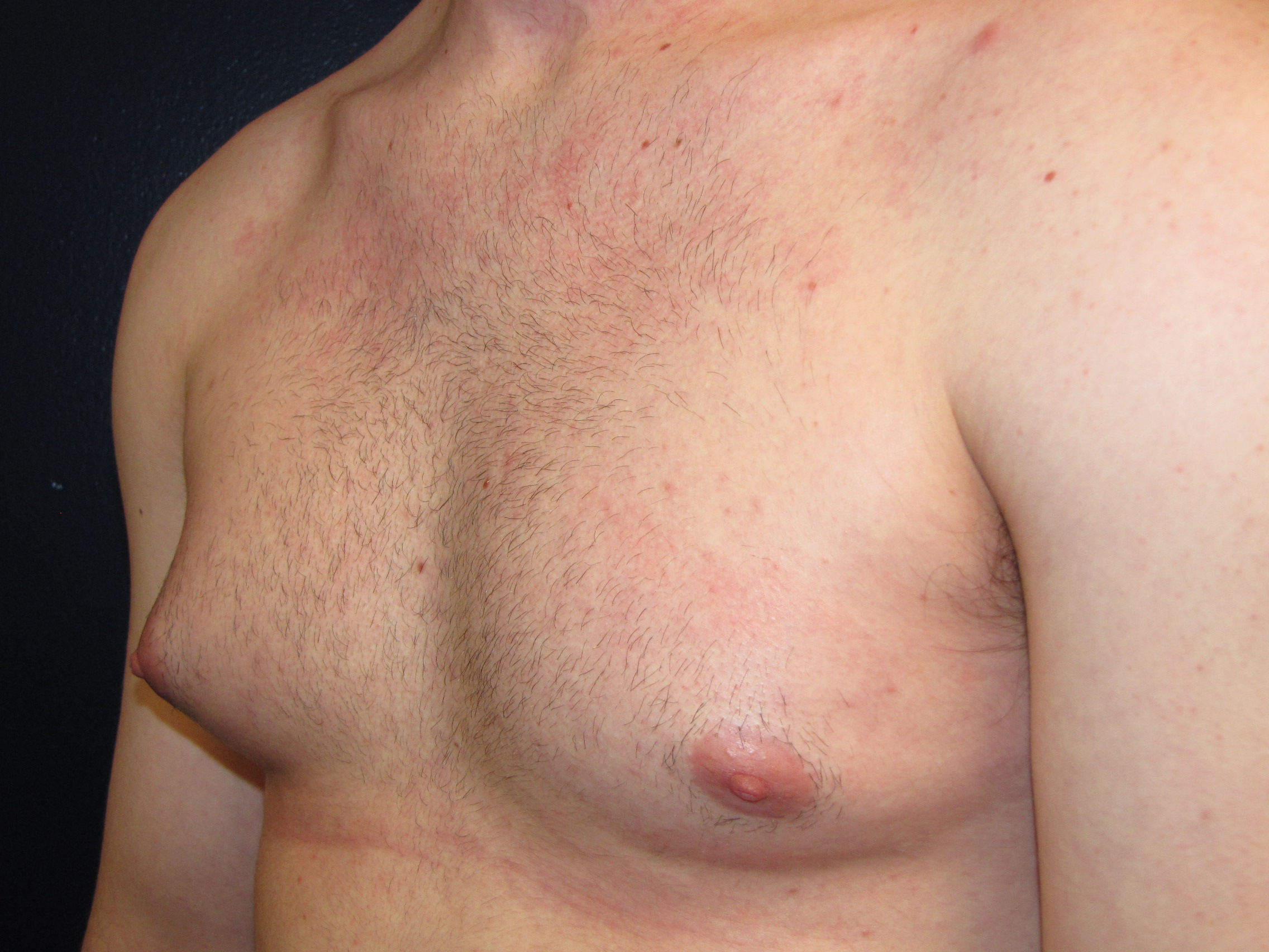 увеличенный сосок груди у мужчин фото 49