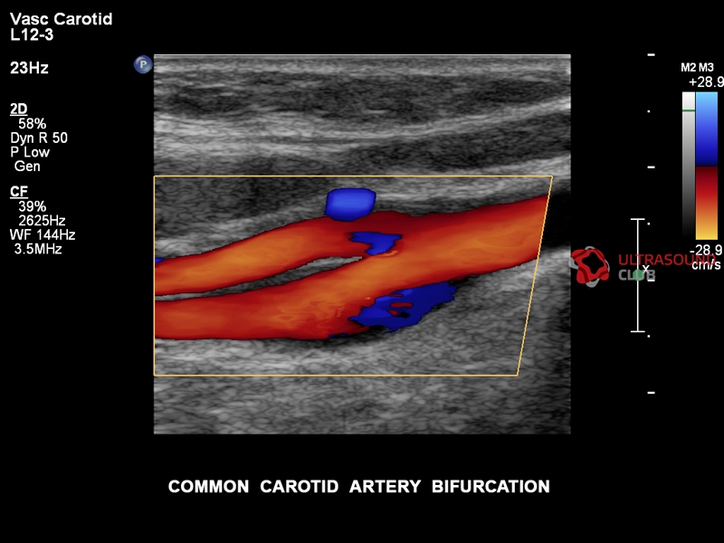 Узи брахиоцефальных артерий фото