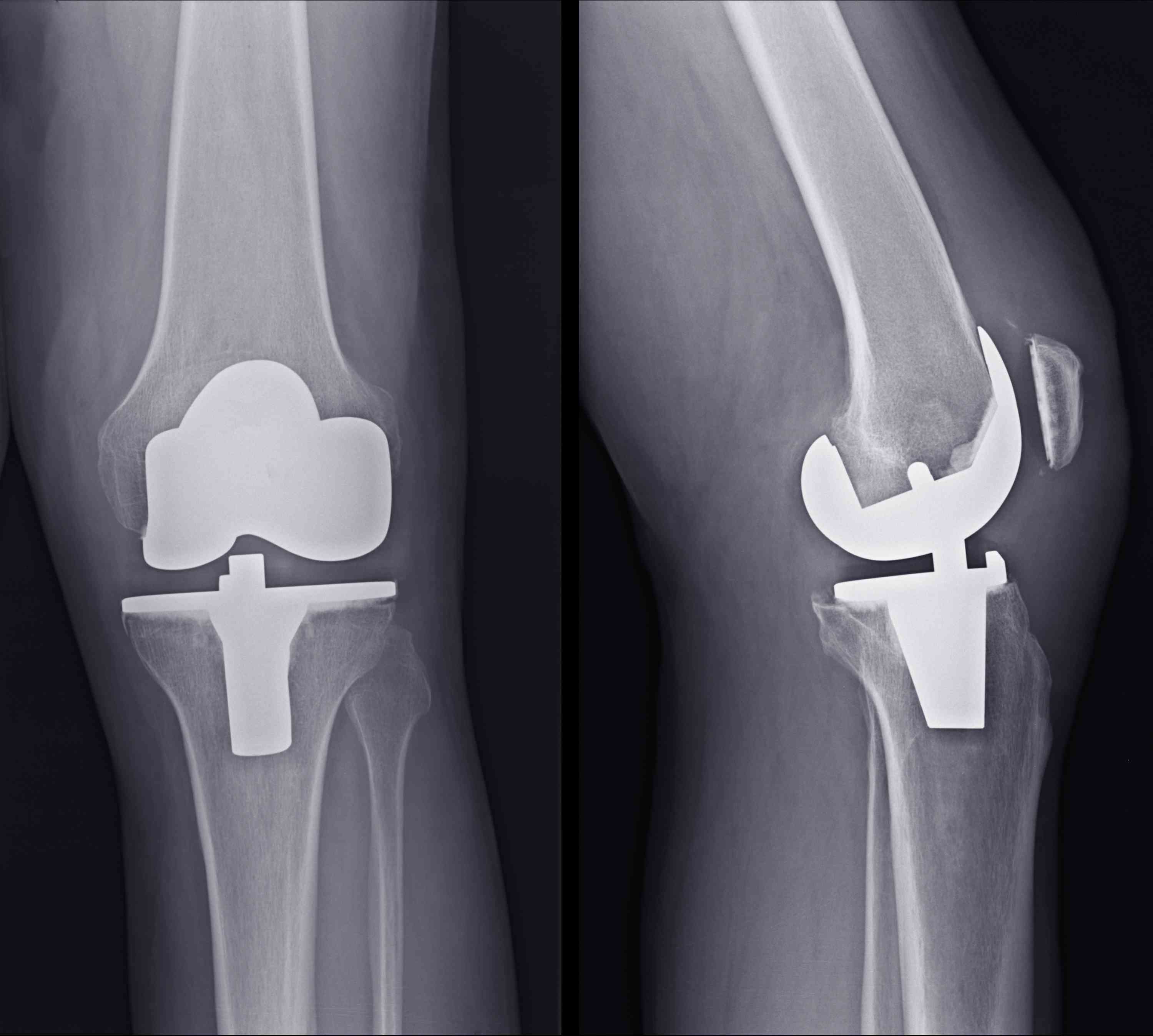 Операция по замене сустава на ноге. Эндопротезирование коленного Stryker. Эндопротезирование коленного сустава рентген. Эндопротез коленного сустава. Тотальный эндопротез коленного сустава рентген.