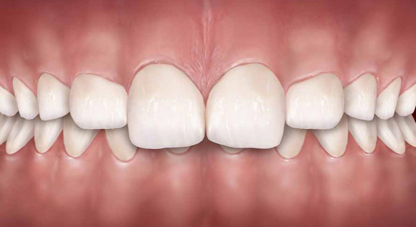 зубной камень передних зубов фото