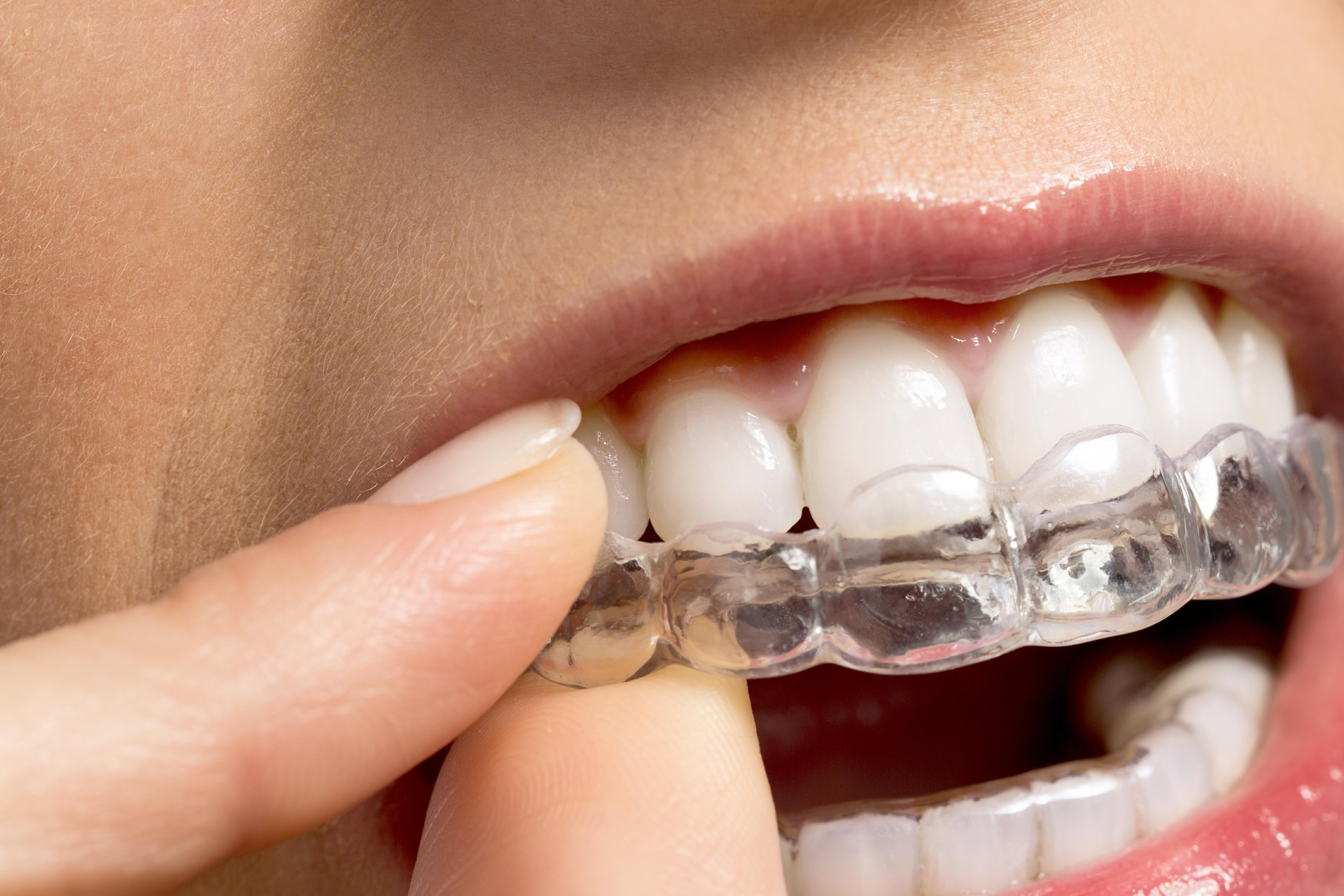 Из за чего скрипят зубами во сне. Элайнеров Invisalign. Каппы Инвизилайн.