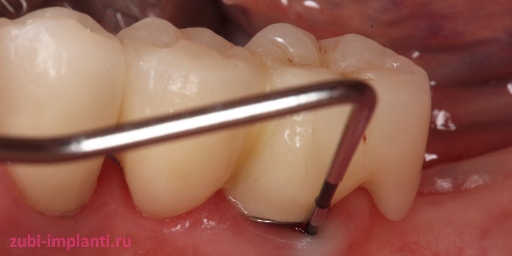 Последствия ошибок стоматолога при имплантации
