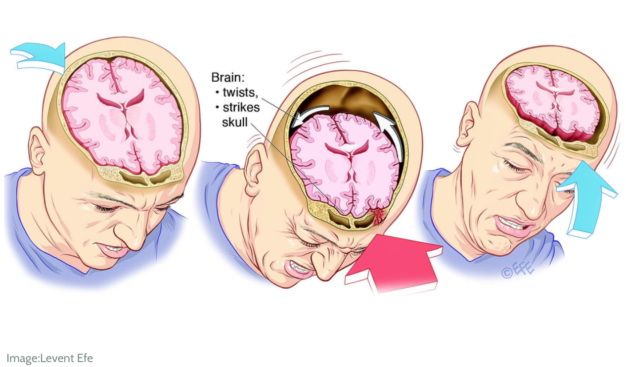 Сотрясение головного мозга. Закрытая травма черепа и головного мозга. Сотрясени еголовоного мозга. ЧМТ сотрясение головного мозга. Легкий удар головой
