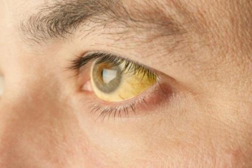 Желтый цвет кожи и белков глаз. Белки желтого цвета означают болезнь? Причины пожелтения глаз