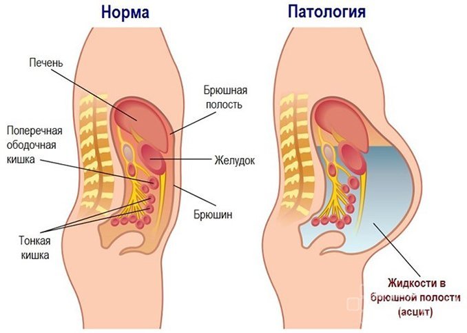 Серозоцеле - скопление жидкости в полости
