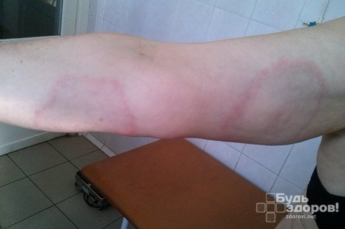 Припухлость округлой формы - основной симптом мигрирующей эритемы