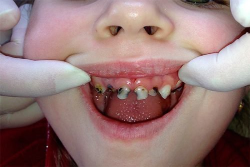 Много больных зубов у ребенка