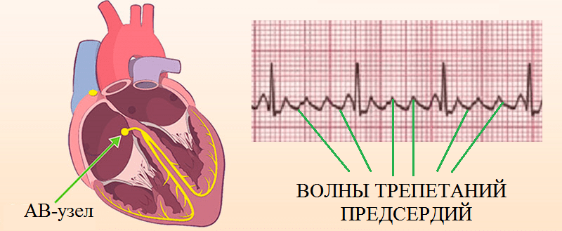 Трепетание предсердий клиническая картина. Фибрилляция предсердий и желудочков на экг. Правильная форма трепетания предсердий 2 1. Ритм при трепетании предсердий. Мерцание или трепетание предсердий.