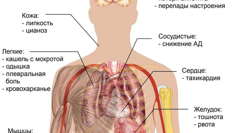 Где болела. При пневмонии болят легкие.