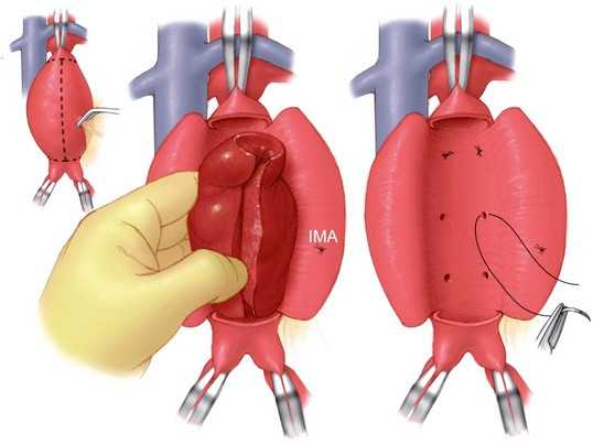 Аневризма аорты операция. Аневризма аорты сердца операция. Операция аневризмы аорты брюшной. Операция протезирования брюшной аорты. Эндопротезирование брюшного отдела аорты.