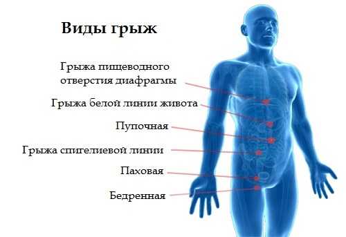 Какие виды грыж бывают