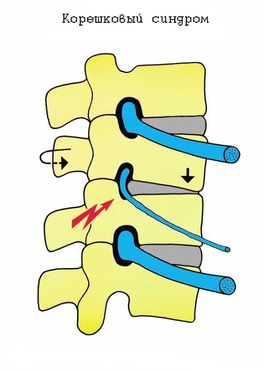 Корешковый синдром поясничного симптомы