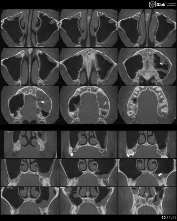 Томография носовых пазух. Кт придаточных пазух носа в 1 проекции. Кт гайморовых пазух носа.
