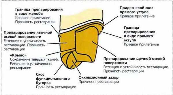 Препарирование под металлокерамическую коронку с уступом в картинках