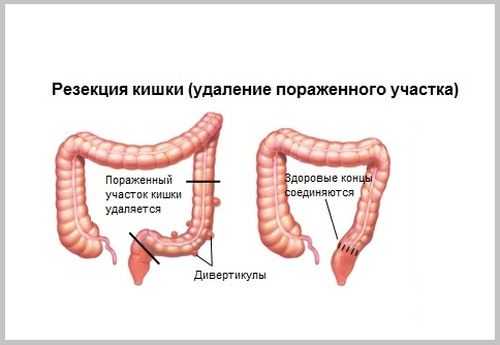 Кишечник Операция Фото