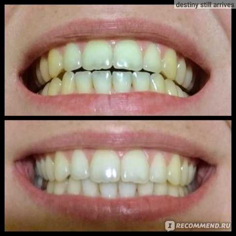 Отбеливание зубов до и после форум монопучковые зубные щетки купить в москве