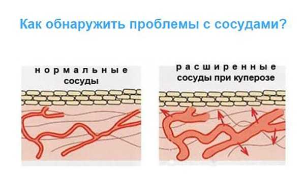 Сосуды кожи. Расширение кожных сосудов. Капиллярная сетка на коже. Механизм развития купероза.