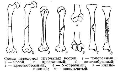 Перелом формы в рисунке