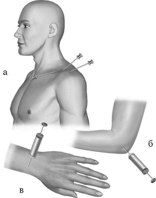 Пункция плечевого сустава. Точки пункции плечевого сустава топографическая анатомия. Точки для пункции лучезапястного сустава. Пункция плечевого сустава точки пункции. Пункция плечевого сустава сзади.