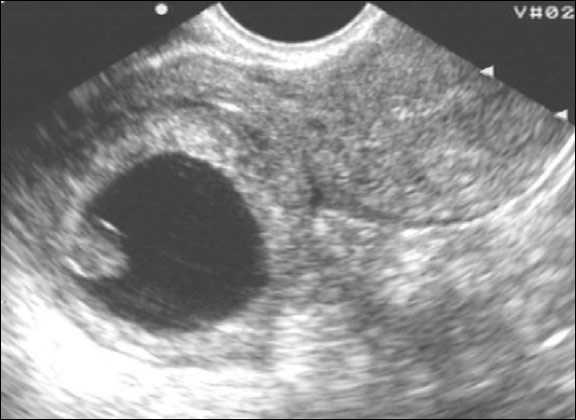 На узи видно внематочную. Внематочная беременность в рудиментарном Роге на УЗИ. Внематочная Трубная беременность УЗИ. Внематочная беременность в рудиментарном Роге. Беременность УЗИ на внематочную беременность.