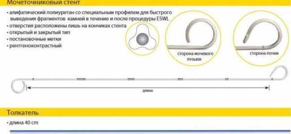 Установка стенда в мочеточник. Стент катетер в мочеточнике. Стенд катетер для мочеточника. Катетер мочеточниковый полиуретановый.